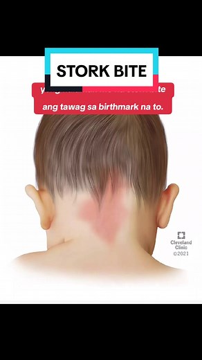 Stork Bite sa Baby: Ano Ibig Sabihin ng Birthmark na Ito?