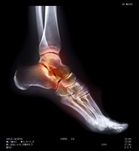 Common Foot Injuries Among Skaters