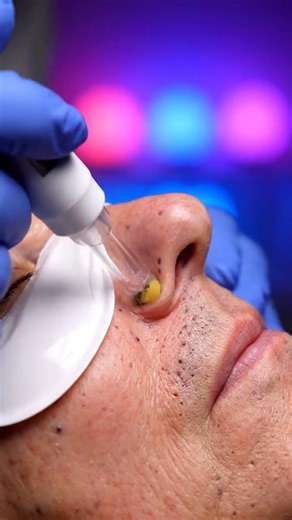 Every Pass Clears the Nose side Pore Vacuum Extraction ASMR3