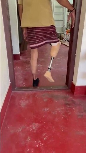 Prosthetic Possibilities: Below-Knee Amputation Success Stories | Dr Girish #shorts