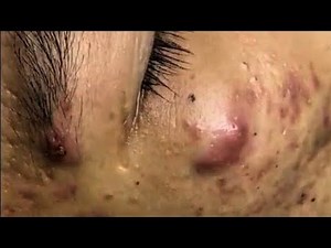 Massive Cyst Extraction