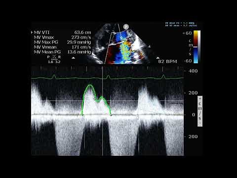 Mitral Regurgitation and PISA calculation