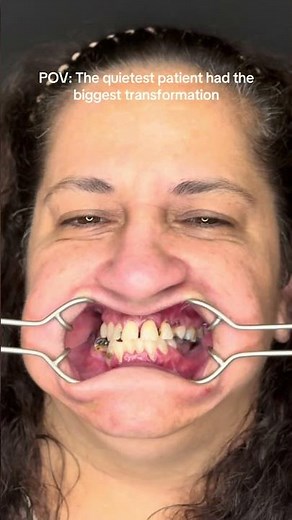 Smile Makeover With Dental Implants 🦷 #dentalimplants #smile