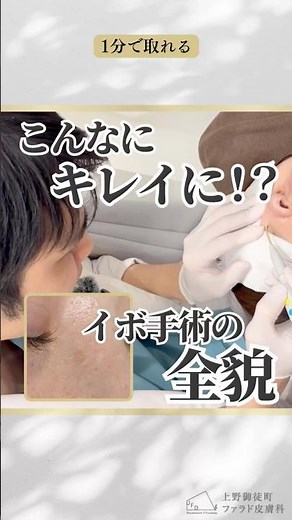 【イボ取りの全貌】 #ファラド皮膚科 #皮膚科専門医 #美容皮膚科 #上野皮膚科 #美施術 #イボ治療