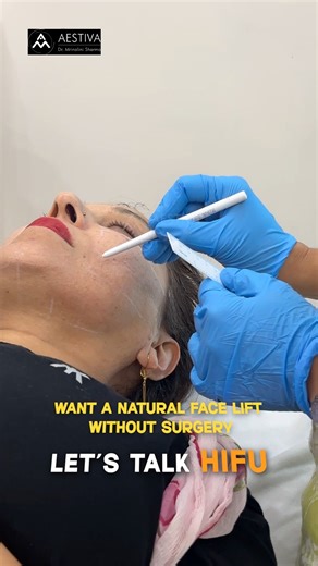 How to get lifted face | Hifu treatment #shorts