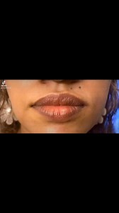 21K views · 58 reactions | Want cherry lips ? Visit 360 wellness and skin clinic #lipfiller #lipfillers #360wellnessandskinclinic #360wellnessbydrcherry #cherrylips #lipenhacement #Fillers #LipGoals #drcherry #aesthetics | Dr. Sarah Fazy / Dr. Cherry | Facebook