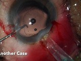 Explaining Broken Intraocular Lens - a Nightmare to Deal with • Video • MEDtube.net