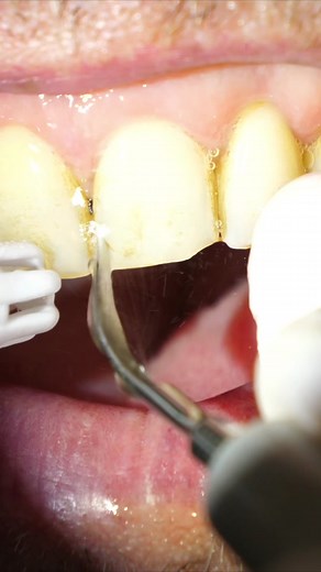 teeth cleaning on heavily stained teeth #smoker #teethcleaning #teethstainremoval