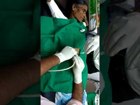 Percutaneous Transhepatic Billary Drainage ( PTBD )(2)