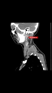#neck #lesions #anatomy #CTScan #CT | CT Scan and MRI study