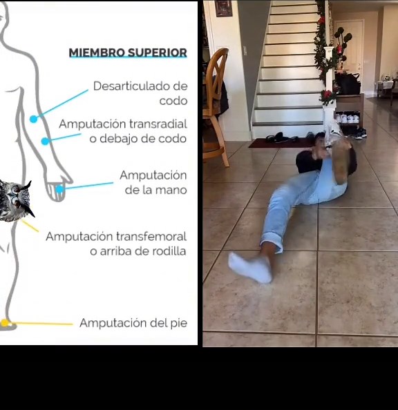 Entendiendo la Prótesis Transfemoral y su Funcionalidad