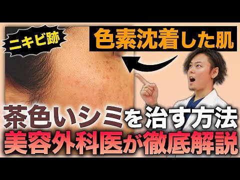 【ニキビ跡】色素沈着した肌・茶色いシミの肌を治す方法を医師が解説！