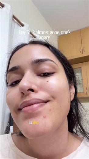 How I got rid of acne in 9 days #acne #acnetreatment #brightskin #ytshorts #skincare #fyp