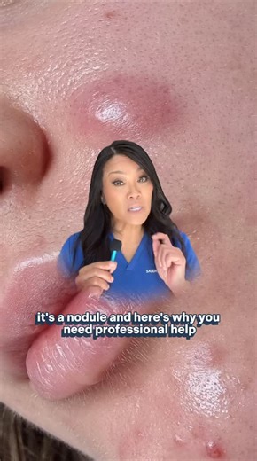 SLMD Skincare by Dr. Pimple Popper on Instagram: "Acne Academy: All About Nodules 👩🏻‍🏫 Here's everything you need to know about one of the deepest and most severe forms of acne.⁠ ⁠ Pro tip: Keep pores clear with salicylic acid o prevent ⁠ ⁠ Follow @slmdskincare for more skin tips!⁠ ⁠ #slmdskincare #acne #nodules #dermatology"