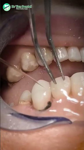 Fiber post with composite restoration #FiberPost#CompositeRestoration#RootCanalTreatment