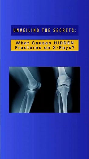 Discover the Hidden Truth: What Causes Fractures on X-Rays?