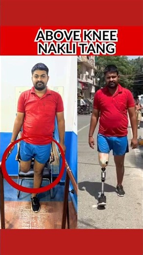 Above knee Artificial Leg #artificialleg #ytshorts #foryou #fyp #shortsfeed #shorts #yt #bornlife