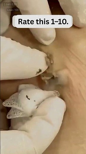 🔥Deep Blackheads, Milia & Whitehead Removal pimple popping New| Big Cystic Acne Extraction#1287 2026