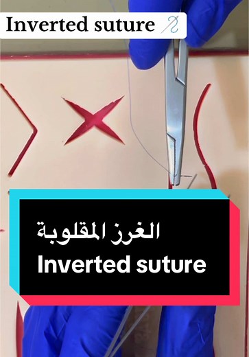 Inverted Sutures Technique for Effective Wound Healing