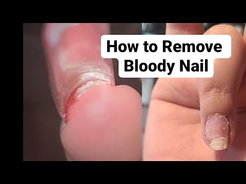 How to remove Nail when HURT AND BLOODY Nail Properly