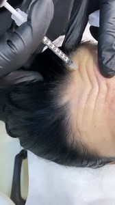 ✔️Toxina botulinica (Botoxul) ajuta pentru relaxarea musculara...