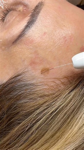 Plasma Lift for Sun Spots☀️ Too much sun? Meet your new best friend: Plasma Lift ✨This treatment targets sun spots, age spots, and uneven pigmentation by using controlled plasma energy ⚡ to gently remove damaged skin cells stimulate fresh, healthy skin 🌱.💎 Benefits:✔️ Fades sun spots age spots✔️ Evens out skin tone✔️ Improves texture brightness✔️ Non-surgical, safe, & effective✔️ Minimal downtime (tiny dots fade in days)✨ Imagine glowing, even skin without heavy makeup ✨📲 DM me today to book 