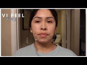 VI Peel Journey | VI Peel Purify | Day of and week of peeling