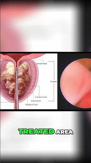 Steam for Your Prostate?