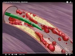 AngioJet animation video