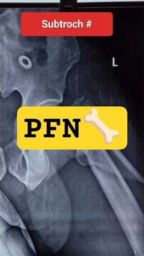 Subtroch# of femur -PFN# subscribe #shorts #ortho