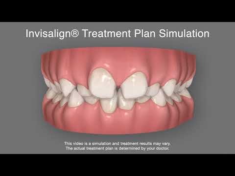 Jet Animation Invisalign® we use at Warrnambool Orthodontic Hub
