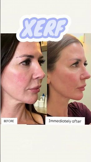 XERF Skin Tightening in Los Angeles | Non-Surgical Face & Neck Rejuvenation | Skin Spa by Dr Kia