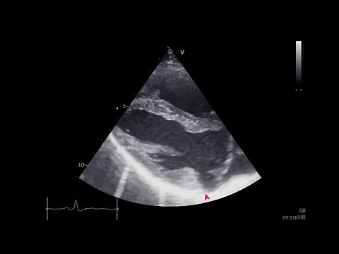 Mitral Annular Disjunction in Marfan Syndrome