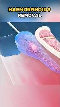How Shockwave Therapy Works | 3D Medical Animation #ShockwaveTherapy #HealthInnovation
