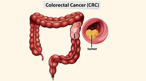 Rectal Cancer: Symptoms, Causes And Treatment