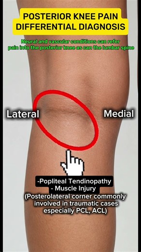 Baker's Cyst: A fluid-filled sac behind the knee, often causing swelling and discomfort.