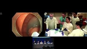 Live EMR for 35mm Polyp in Ascending Colon