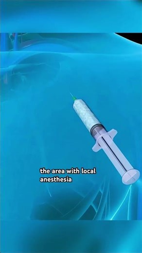 How Heart Pacemaker Works? (3D Animation) #ekgtech #echocardiography #ecg #ecgs #cannulation