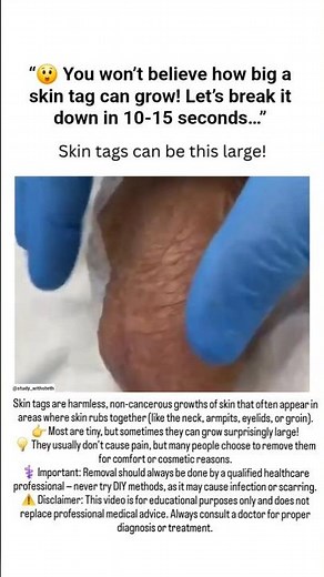 😱 Skin Tags Can Grow THIS Big?! | Shocking Medical Fact Explained