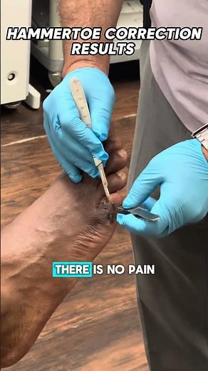 Hammer toe correction results!