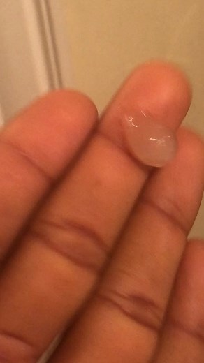 ❗️Sinus Anomaly: Jelly-like Spherical Mucus Blocking Sinuses