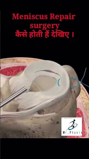 Meniscus Repair in 3D Animation