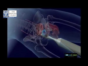 HIFU for Prostate Ablation • Video • MEDtube.net