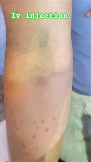 Intravenous injection use l iv injection लगाना सिखे !! #ivinjection #short