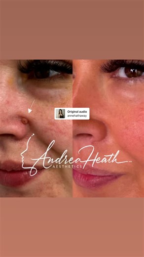 I specialise in mole removal using cutting-edge plasma pen technology. This safe, non-surgical treatment is designed to effectively remove moles with minimal discomfort, downtime, and scarring. How Plasma Energy Mole Removal Works: My emits a focused electrical arc that gently vaporises the mole layer by layer, ensuring precision and preserving healthy surrounding skin. This advanced technique eliminates the need for cutting or stitches, promoting faster healing and natural-looking results. Bene