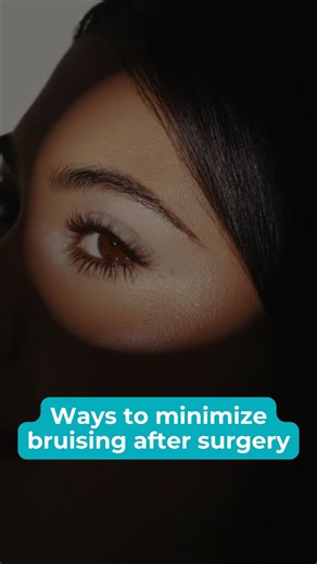 To minimize bruising after surgery, we start early: epinephrine in the local anesthetic reduces bleeding, and TXA (tranexamic acid) in the IV helps limit bruising during the procedure. After surgery, immediate cold compresses and gentle pressure are key to calming the clotting process and keeping bruising to a minimum. | Dr David B Samimi, Eyesthetica | Facebook