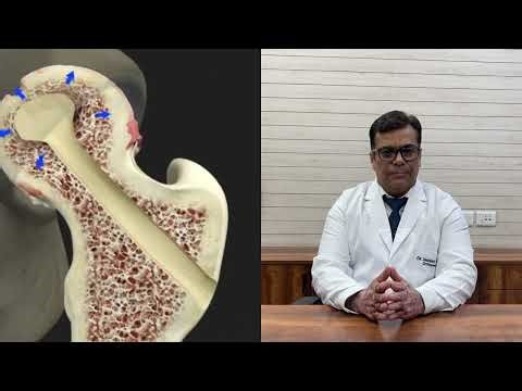 Avascular Necrosis (AVN) Hip Treatment Options Explained | Dr. Manish Aroraa | Ortho Surgeon