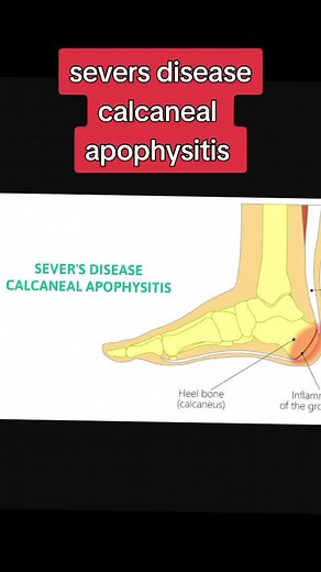 Understanding Sever's Disease: Causes, Symptoms, and Treatment