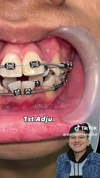 Braces Progress: Severe Crowding Treatment Journey