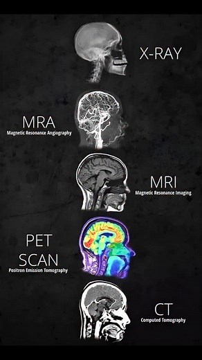 World of biology backup on Instagram: "Brain Imaging Techniques Compared 🧠🔍 Each tool offers a unique window into the brain. Here's how they differ 👇 1. X-Ray: Best for visualizing bones — helps detect skull fractures or trauma. 2. MRA (Magnetic Resonance Angiography): Highlights blood vessels — ideal for spotting aneurysms or vascular blockages. 3. MRI (Magnetic Resonance Imaging): Delivers high-resolution images of soft tissue — used to identify tumors, strokes, or inflammation. 4. PET Scan